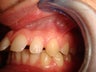 Invisalign