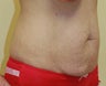 Tummy tuck
