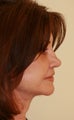 Facelift