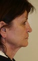 Facelift
