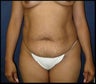 Tummy tuck