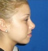 Rhinoplasty