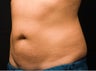 Cool Lipo