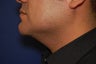 Liposuction