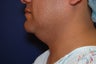 Liposuction