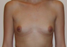 Breast Implants