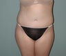 Female patient who underwent a tummy tuck 