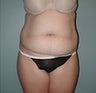 Female patient who underwent a tummy tuck 