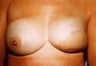42 year old female patient 