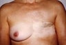 42 year old female patient 