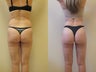 Liposuction