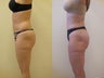 Liposuction