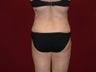 Liposuction
