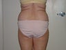 Liposuction