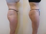 Brazilian butt lift
