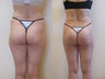 Brazilian butt lift