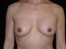 Breast Implants