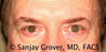 Eyelid Surgery