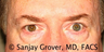Eyelid Surgery