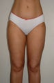 Liposuction