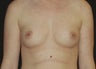 Breast Augmentation