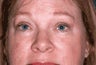 Eyelid Surgery