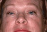 Eyelid Surgery