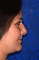 Rhinoplasty