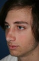 Rhinoplasty