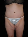 Tummy tuck
