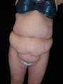 Tummy tuck