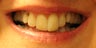 Porcelain Restorations: Bridge, Crowns, and Veneers