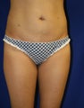 Smart Lipo