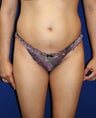 Smart Lipo