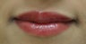 Lip augmentation
