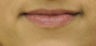 Lip augmentation