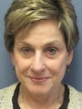 Neck Lift on 73-year-old