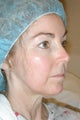 Facelift