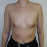 Breast Augmentation