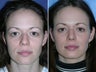 Rhinoplasty