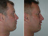 Revision rhinoplasty