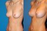 Breast Augmentation