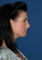 Nose surgery