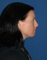 Nose surgery