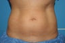 CoolSculpting