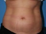 CoolSculpting