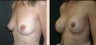 Breast Augmentation