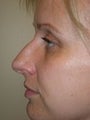 Rhinoplasty