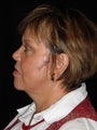 Neck lift