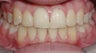 Severe crowding and unilateral crsosbite